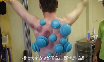 拔罐的黑印真的是体内毒素吗?专家给出解释,很多人不相信