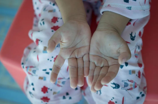 关于手足口病的8个常见误区，一次说清！
