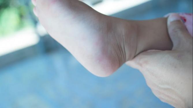 手足口病秋季小高峰，个人、家庭、学校、托幼机构防护要点→
